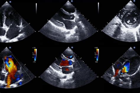 Understanding the echocardiogram .